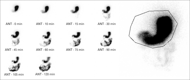 What Is A Nuclear Gastric Emptying Test